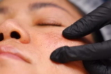 What Causes Melasma and How It’s Treated