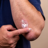 Herpes Skin Rash: Symptoms,Treatment, and Prevention