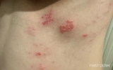 Herpes Zoster (Shingles)