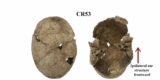 Flat Head Syndrome in 42% of Iron Age Italians