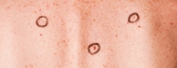 Amelanotic Melanoma: Symptoms, Causes & Treatment