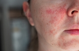 When Alma Veil May Help Uneven Skin Tone