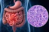 Rare Intestinal Lymphoma Case Highlights Risks of Poorly Controlled Celiac Disease