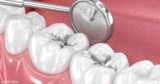 End System of Choice for the Rich and Mercury for the Poor! Help Bring Mercury-Free Dentistry to All