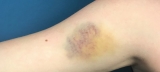 Yes, Bruising Gets Worse As We Age