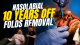 Erase Smile Lines & Wrinkles: Nasolabial Fold Transformation