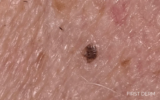 Malignant Melanoma