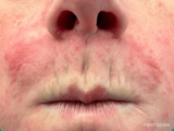 Perioral Dermatitis –