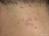 Spots and Rashes Caused by Viruses – Exanthem