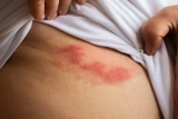 ‘What Is Shingles?’ and Other Shingles FAQs Answered