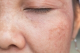 How can I remove unwanted sun damage?