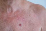 What is the most common skin cancer and how can I diagnose and treat it?