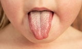 What are the symptoms of scarlet fever and is it contagious? – UK Health Security Agency
