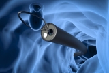 The Most Common Types of Colon Polyps We Discover During a Colonoscopy