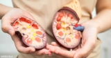 Women with Kidney Disease Are Undertreated and Left Behind by Decades of Male-Dominated Research