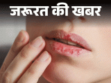 Winter Lip Crack; Prevention And Home Remedies | Health Care Tips | जरूरत की खबर- सर्दियों में क्यों फटते हैं होंठ: डर्मेटोलॉजिस्ट से जानें कारण और बचाव के तरीके, विंटर लिप्स केयर के 15 टिप्स